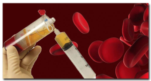 PRP Injection being prepared