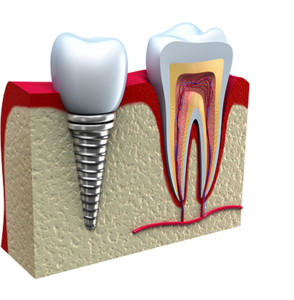 PRP with dental implants