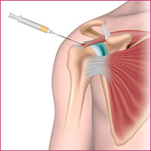 prp-ligament-injection