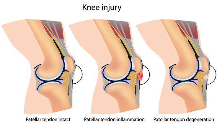 PRP Patellar Tendinitis