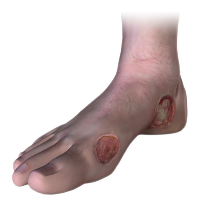 wound-care wound-care