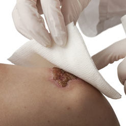 PRP Wound Care